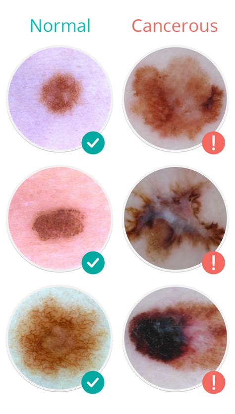 MoleScope™ | Skin Cancer Signs & Symptoms