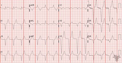 Accelerated Idioventricular Rhythm | ECG Stampede