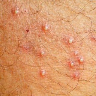 Folliculitis - Dermatologist in Lake Worth, FL | Palm Beach Dermatology