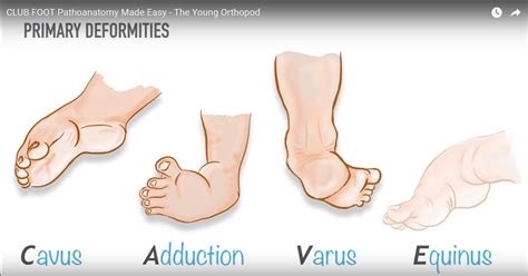 Congenital Talipes Equinovarus — OrthopaedicPrinciples.com