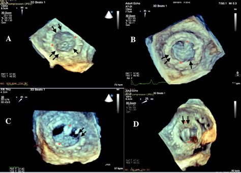 In patients with a Carbomedics mitral bileaflet prosthetic valve, a ...