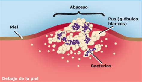 Cuánto tarda en curarse un absceso