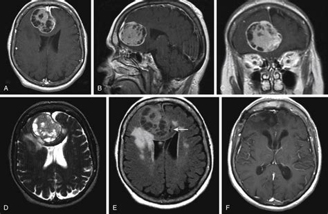 Surgical Approach to Falcine Meningiomas | Clinical Gate