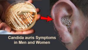 Candida auris Symptoms in Men and Women should never be ignored!