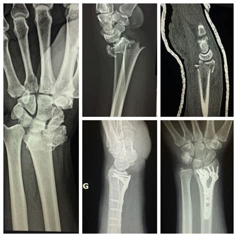 Broken Wrist Surgery for Adults and Kids in Raleigh NC - John Erickson, MD