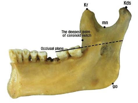 Mandibular Foramen Anatomy