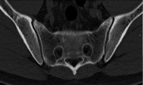 Figure 5 from Sacroiliitis – Findings on Conventional Radiography, CT ...