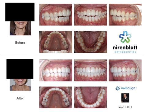 Our blog - Nirenblatt Orthodontics | Charleston North Charleston SC