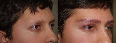 Eyebrow Transplantation Photos | Miami, FL | Patient 16541