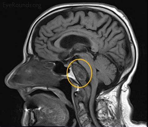 Cranial nerve VI (abducens nerve) innervates the lateral rectus muscle ...