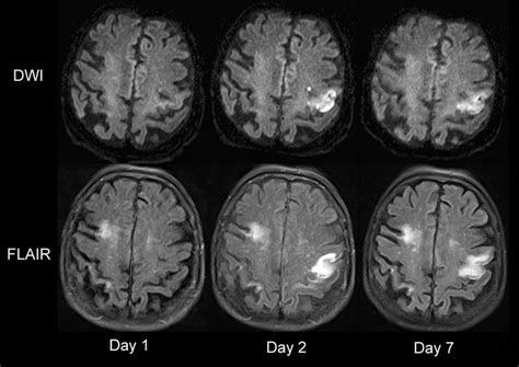 Complete Early Reversal of Diffusion-Weighted Imaging Hyperintensities ...