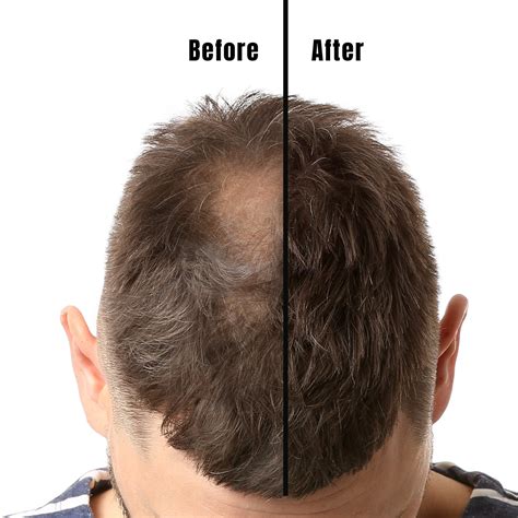 How Long Will Minoxidil Results Take? & Minoxidil Before & After