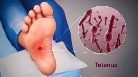 Tetanus - Symptoms, Causes, & Treatment - Scientific Animations