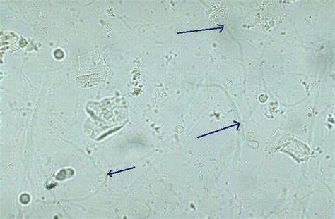 Mucus thread | Medical laboratory, Medical laboratory technician ...