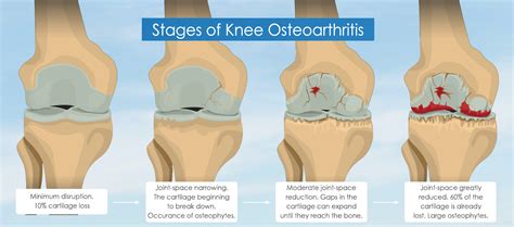 What is Osteoarthritis ? — The PRP Clinic