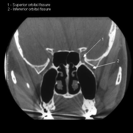 Inferior Orbital Fissure Ct