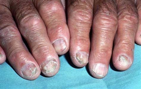 Nail fungus infection, causes and how to get rid of nail fungus infection