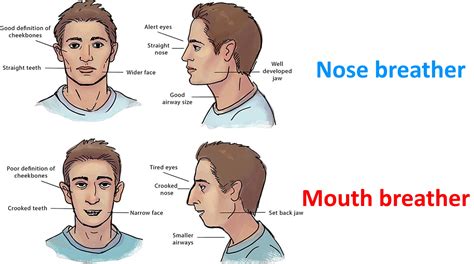 Does Overbite Cause Weak Chin