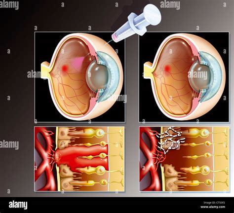 AMD TREATMENT, ILLUSTRATION Stock Photo - Alamy