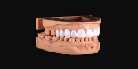 Diagnostic Wax-Up • HEX Dental Lab