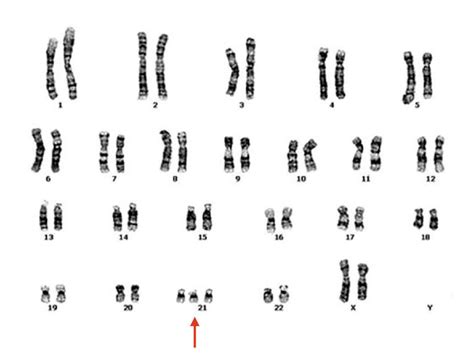 Trisomy 21 (Down Syndrome): Definition, Causes, Symptoms, Pictures and ...