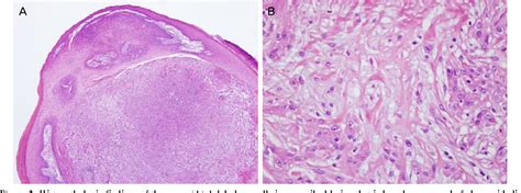 Figure 2 from A Case of Eyelid Desmoplastic Trichilemmoma | Semantic ...