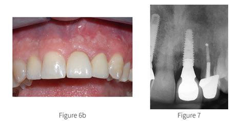 Maxillary Central Incisor Implant Supported Crown - Osstell®