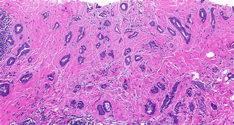 Invasive Ductal Carcinoma Histology