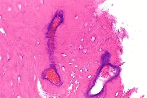 Osteoid Osteoma Histology