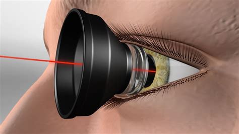 Focal Retinal Laser Procedure - Fraser Valley Cataract & Laser