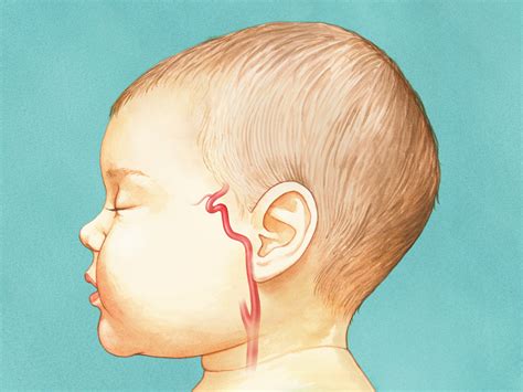 Intra-Arterial Chemotherapy for Intraocular Retinoblastoma – Art as ...