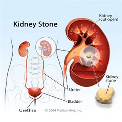 Kidney stone disease