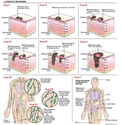 Melanoma Skin Cancer Stages