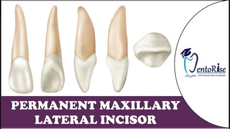 Image Result For Maxillary Lateral Incisor Drawing Dental Anatomy | The ...