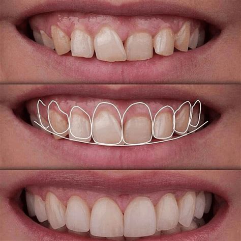 What is the difference between gingivectomy and gingivoplasty? | News ...