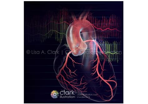 FFR and iFR used to Evaluate Coronary Stenosis | Clark Medical Illustration