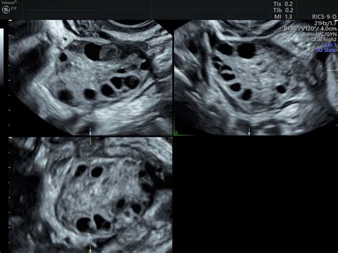 PCOS in Teens | Diagnosing PCOS With Ultrasound | Empowered Women's Health