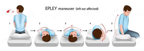 Epley Maneuver Left Ear Affected Vector Illustration Stock Vector ...