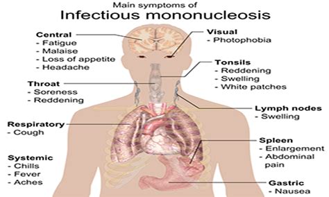 Ten Striking Facts About Mono Disease - A Knowledge Archive