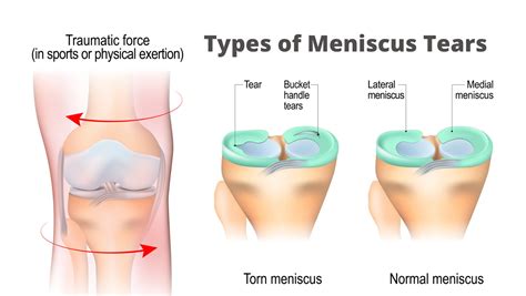 What is a meniscus tear? - Bone & Joint