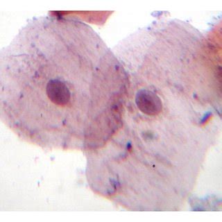 Photomicrograph showing epithelial cells with nuclear pleomorphism ...