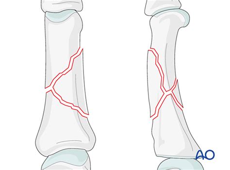 Wedge/multifragmentary fracture of the diaphysis