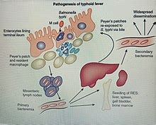 Typhoid fever - Wikipedia