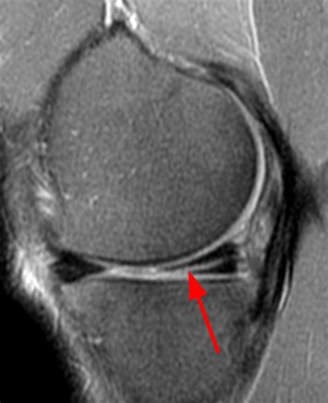 Meniscus Tear: Symptoms, Causes, and Diagnosis