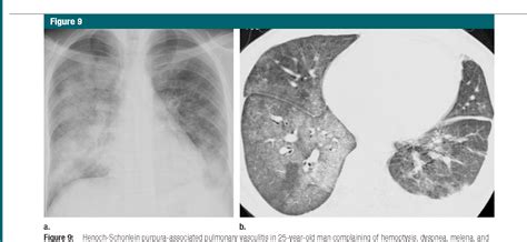 Figure 2 from Imaging of pulmonary vasculitis. | Semantic Scholar