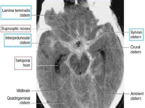 Cisterns of brain and its contents along with its classification and