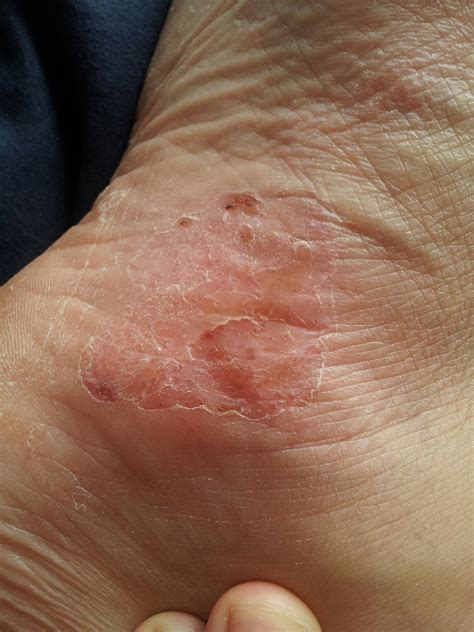 Pompholyx - an extreme eczema of the hands or feet