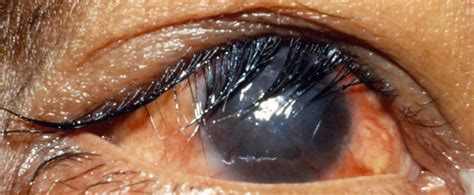 Trichiasis | The Canadian Association of Optometrists