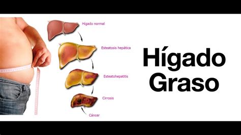 Hígado graso: Síntomas, Diagnóstico, Tratamiento y Prevención ...