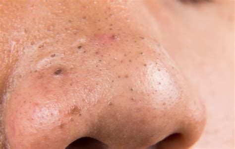 Blackheads Meaning, Formation, Causes and Treatment - Skincarederm